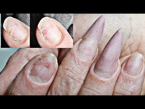Видео: Очень сложная коррекция ногтей/глубокая трещина что с ней делать/коррекция нарощенных ногтей