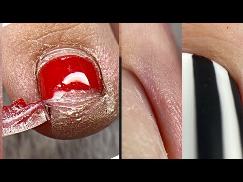 Видео: Оторвало ноготь😬Педикюр на клиенте💅Дарю промокод😍