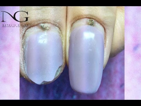 Видео: Вопрос/ответ:болезни, травмы ногтя в зоне кутикулы / Illness and injury near cuticle