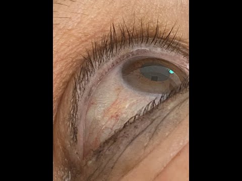 Видео: УЗИ желчного пузыря. Дилатация холедоха.