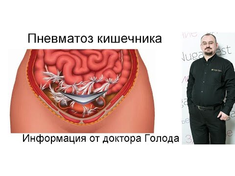 Видео: Пневматоз кишечника - что это такое и как это лечить?