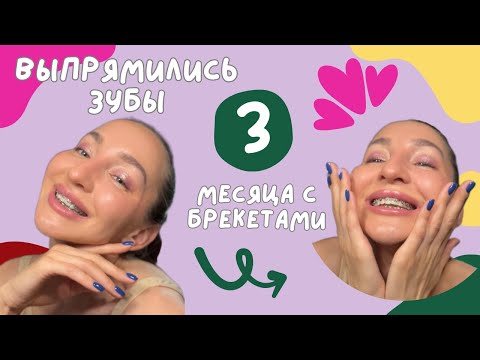 Видео: Выпрямились очень кривые зубы🎉🎈3 месяца ношу брекеты