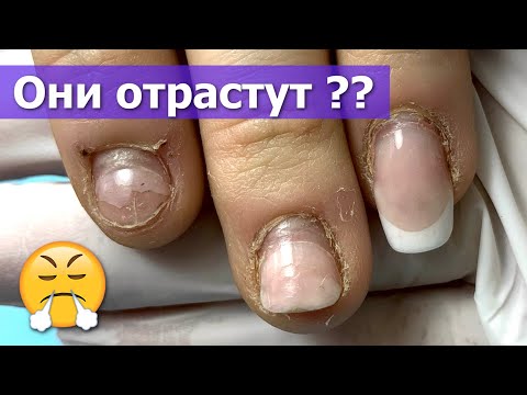 Видео: Наращивание на Обгрызенные ногти спустя 5 НЕДЕЛЬ - что осталось ?
