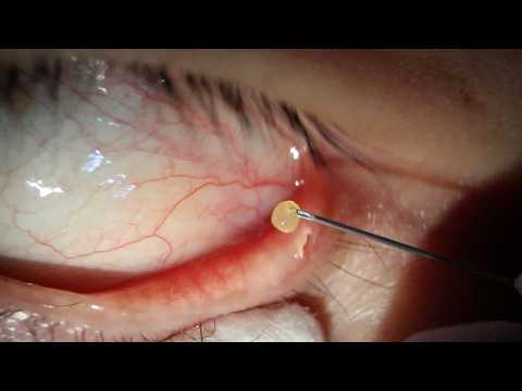 Видео: Лечение ячменя. Выглядит очень болезненно. Серия 28