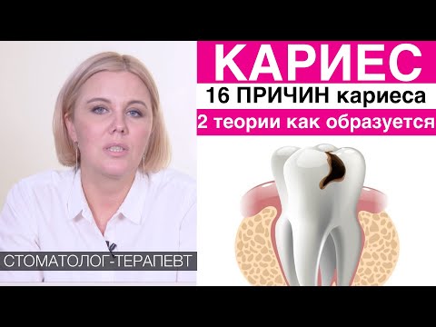 Видео: Кариес - причины появления кариеса, стадии развития кариеса. Диагностика кариеса