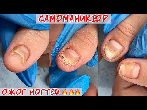 Видео: Ожог ногтевой пластины / Сам себе мастер маникюра