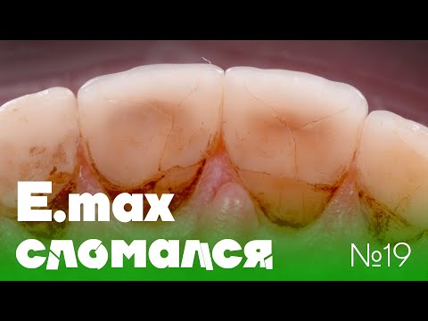 Видео: E.max сломался | Дентал Кейсы от BG #19