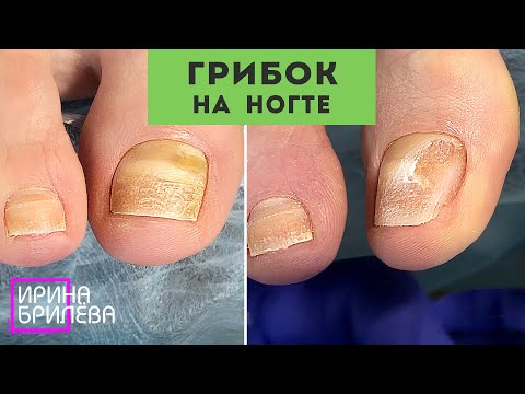 Видео: ГРИБОК на большом пальце 🌸 ЧТО ДЕЛАТЬ и как реагировать? 🌸 Проблемный педикюр 🌸 Ирина Брилёва