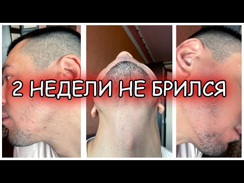 Видео: МИНОКСИДИЛ | 4-Й МЕСЯЦ | КУПИЛ МЕЗОРОЛЛЕР | РЕШИЛ ПРОБЛЕМУ ШЕЛУШЕНИЯ