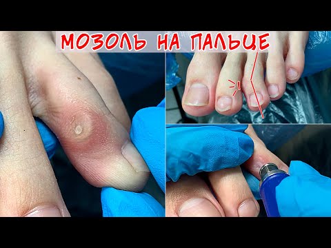 Видео: Удаление стержневой мозоли на ноге 🦶