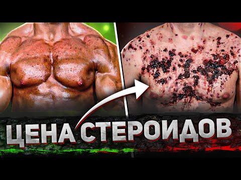 Видео: ГНИЮЩАЯ КОЖА СЛАЗИЛА ОТ ХИМИИ / откровения бывшего химика