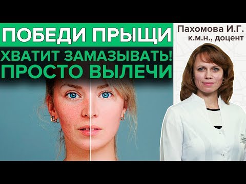 Видео: КАК ИЗБАВИТЬСЯ ОТ ПРЫЩЕЙ | Надёжный способ вылечить акне