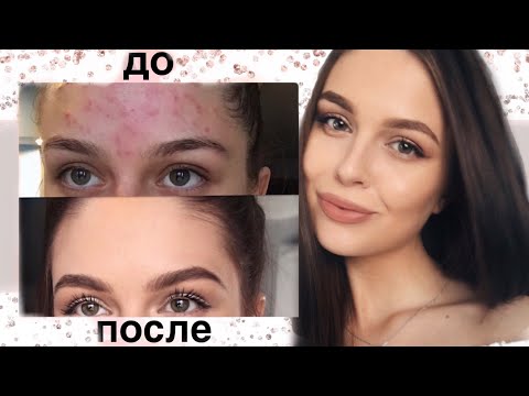 Видео: КАК ИЗБАВИТЬСЯ ОТ ПРЫЩЕЙ ?! МОЯ ИСТОРИЯ