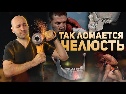 Видео: Самые необычные причины переломов нижней челюсти.