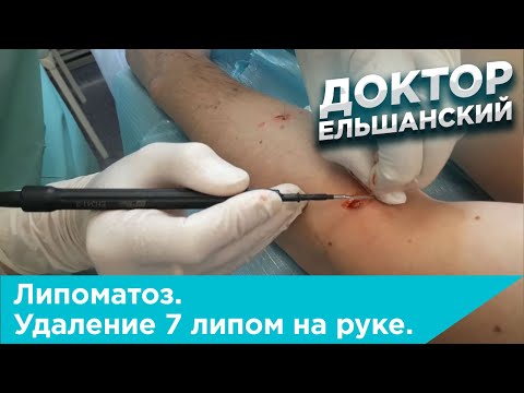 Видео: Липоматоз. Удаление 7 липом на руке.