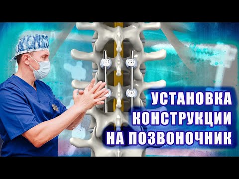 Видео: Установка конструкции на позвоночник! Александр Печиборщ
