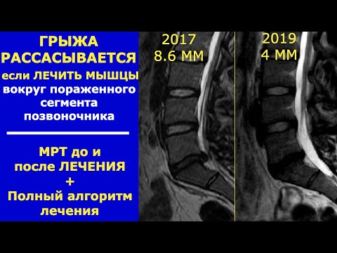 Видео: Может ли грыжа исчезнуть? Резорбция грыжи диска позвоночника. 14+