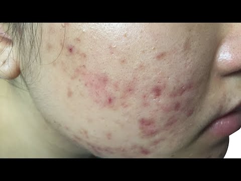 Видео: Почему начинается АКНЕ
