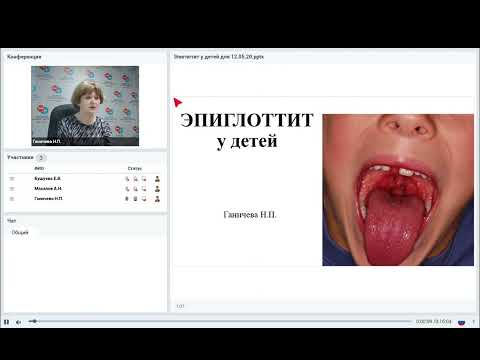 Видео: Эпиглоттит у детей.   Доцент Ганичева Н.П.