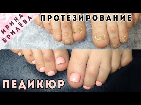 Видео: Сложный ПЕДИКЮР 👣 Укрепление ногтей полигелем