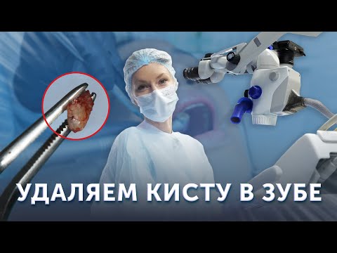 Видео: Удалили кисту для сохранения зуба | Апикальная хирургия