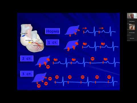 Видео: Синоатріальні та міжпередсердні блокади