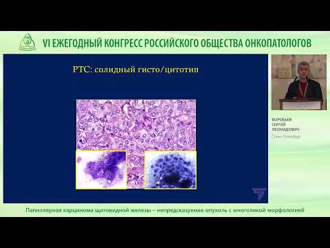 Видео: Папиллярная карцинома щитовидной железы – непредсказуемая опухоль с многоликой морфологией