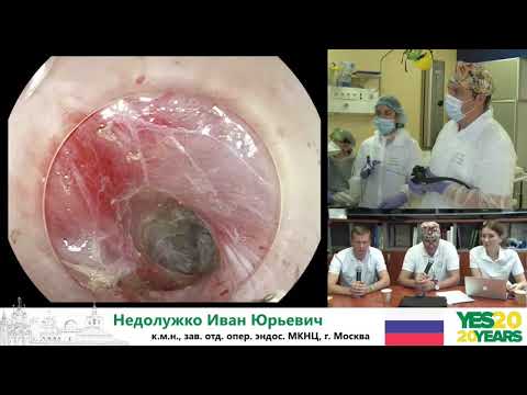 Видео: 27. ПОЭМ при ахалазии. И. Ю. Недолужко