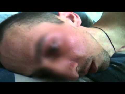 Видео: Дифференциальная диагностика мутизма и афазии