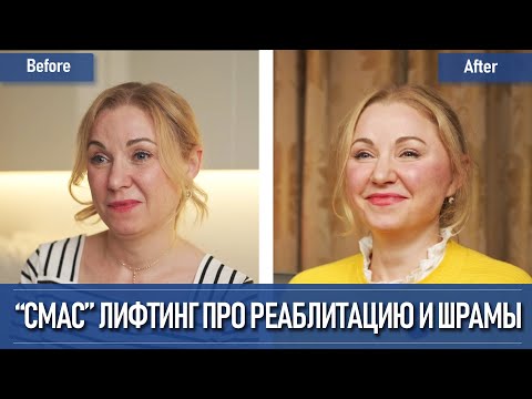 Видео: Лифтинг лица о шрамах и реабилитации, отзыв о лифтинге в Южной Корее