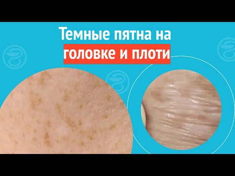 Видео: 👉 Темные пятна на головке и плоти. Клинический случай №1300