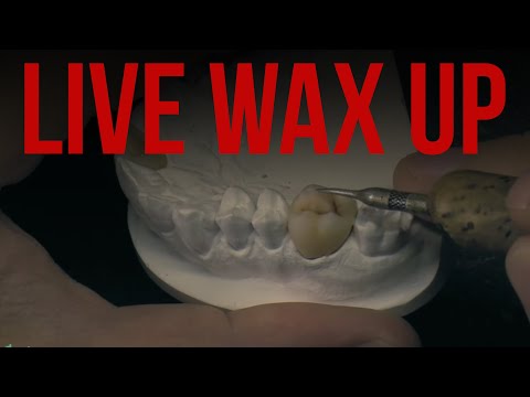 Видео: Live wax up. waxup modeling. Modeling tooth molar wax. Восковое моделирование