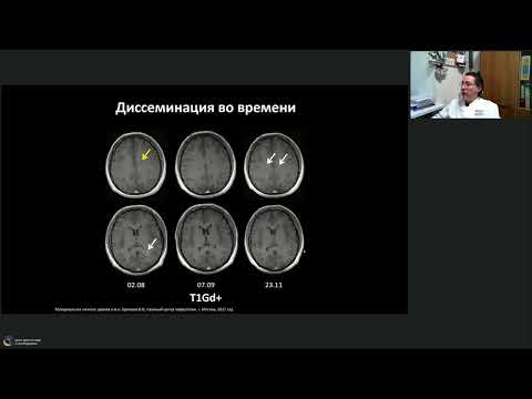 Видео: Вебинар МРО РОРР: МРТ- диагностика при рассеянном склерозе в дебюте и в динамике