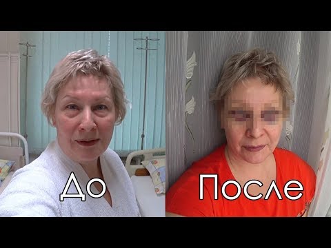 Видео: 18.03.20 БЛЕФАРОПЛАСТИКА.   Мой опыт. Стоит ли? 1-я часть.