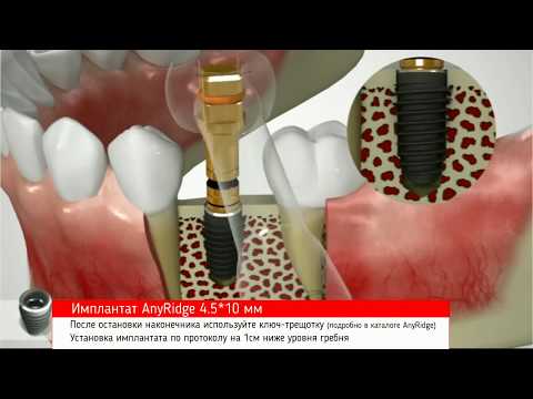 Видео: AnyRidge, протокол сверления костной ткани типа D2