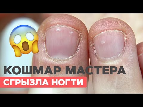 Видео: Что делать? Сложные ногти |Преображение обгрызенных ногтей