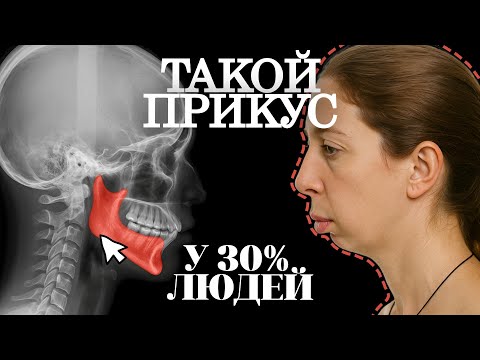 Видео: Почему у тебя маленькая челюсть и подбородок? Лечение дистального прикуса 5 типов