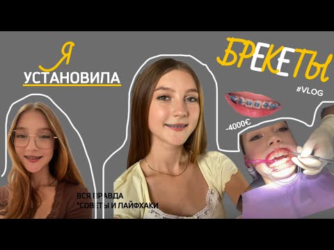 Видео: VLOG: Я ПОСТАВИЛА БРЕКЕТЫ!! *первые ощущения* первый месяц с ними….