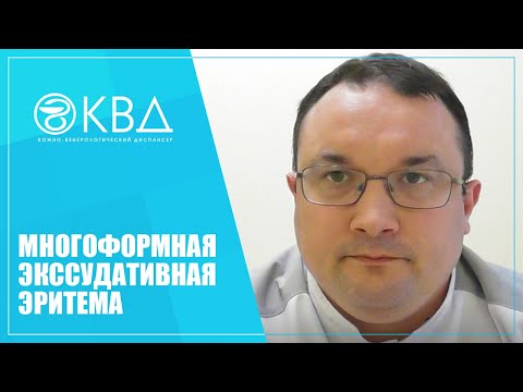 Видео: 1174  Многоформная экссудативная эритема