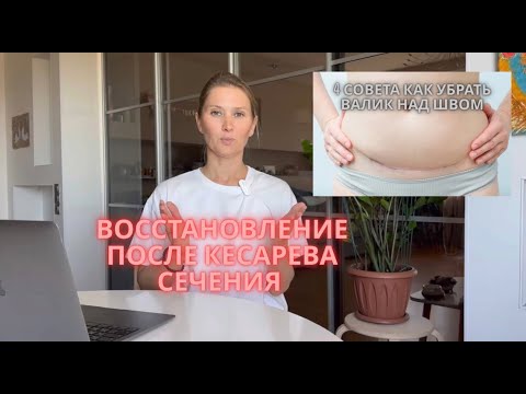 Видео: Как сделать живот плоским после кесарева сечения