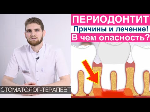 Видео: Периодонтит - симптомы, причины, последствия, лечение периодонтита. Профилактика, лечение