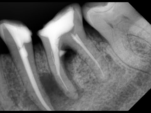 Видео: Лечение перфорации в области фуркации корня. Лечение периодонтита. Курсы по стоматологии