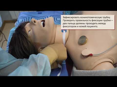 Видео: Хирургическая коникотомия без расширителя Труссо набором MINI-TRACH I