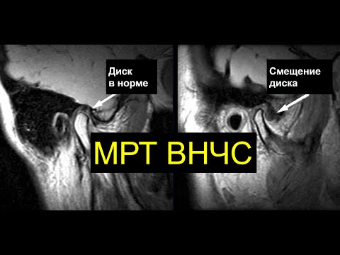 Видео: МРТ ВНЧС все секреты от Ивана Комолова (как делать, куда смотреть)