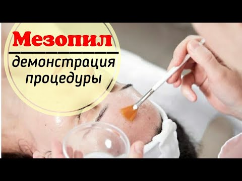 Видео: Дермапен с пилингом. Мезопил.  Демонстрация процедуры