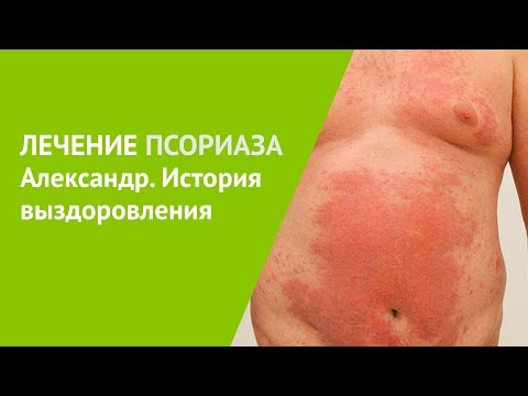 Видео: Лечение псориаза. Александр, история выздоровления