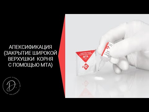 Видео: Апексификация - закрытие широкой верхушки корня с помощью МТА