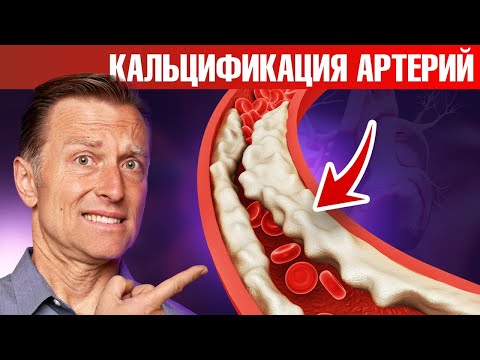 Видео: Кальцификация артерий и сосудов? Вот что к этому приводит...👀