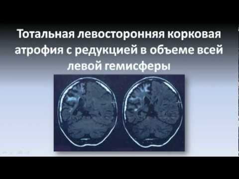 Видео: Энцефалит Расмуссена. Часть 1.