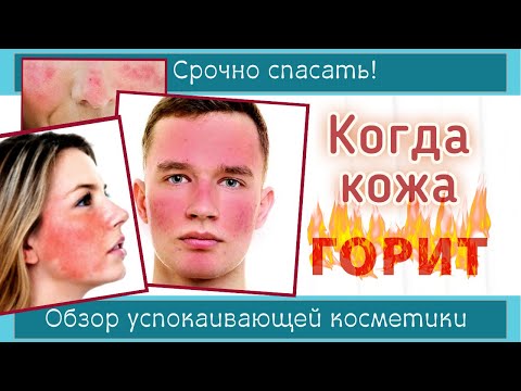Видео: SOS-УХОД для ПРОБЛЕМНОЙ КОЖИ | Покраснение лица - как помочь